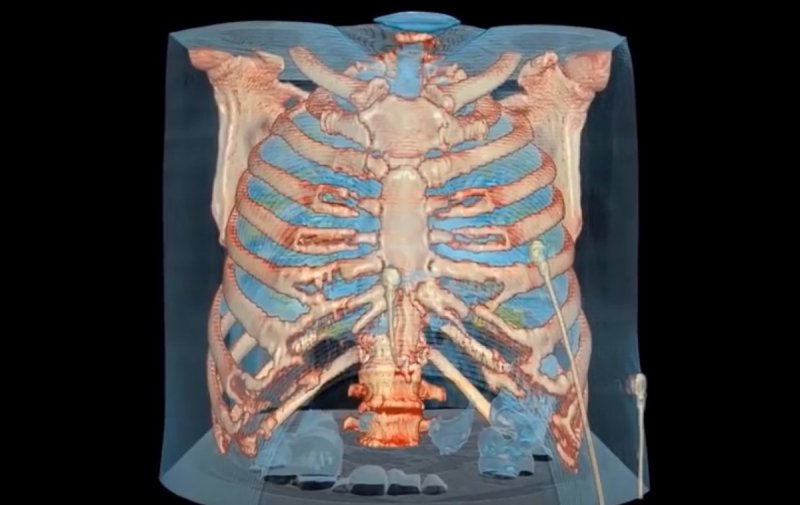 Este es el video que representa el daño que el Covid-19 hace a los pulmones