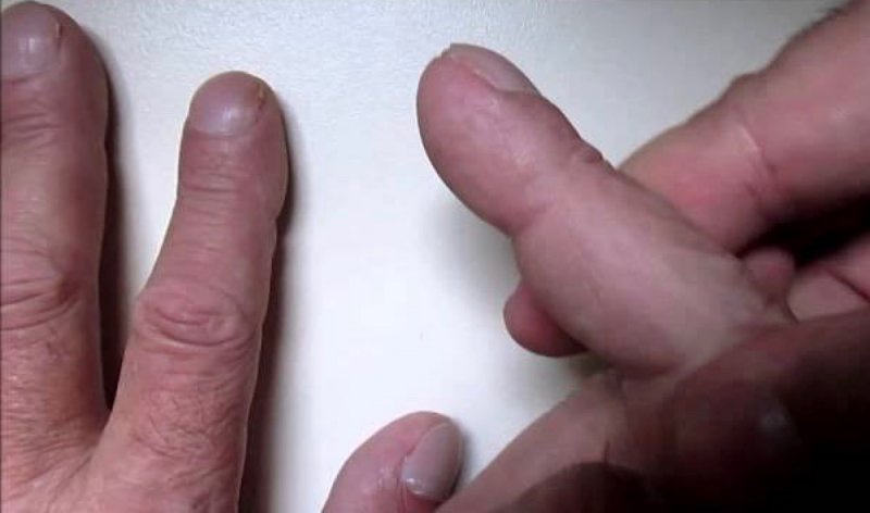 La forma de tus dedos podría decirte a tiempo si tienes o no cáncer. 