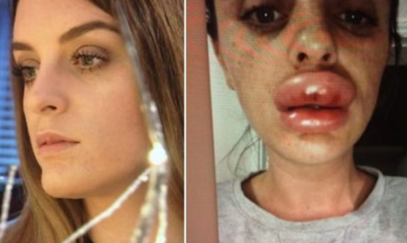 Chica asiste a fiesta de bótox y termina con los labios deformes (FOTO)