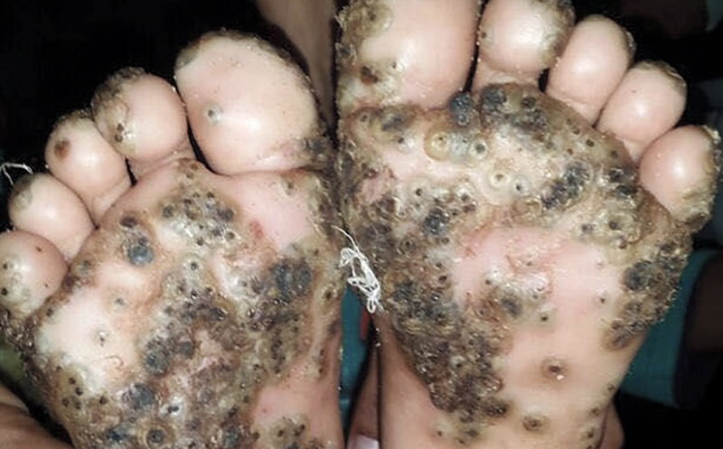 Niña de 10 años SUFRE terrible INFECCIÓN por PULGAS en los pies
