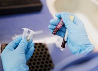 Nuevo análisis de sangre detecta tumores cancerígenos 4 años antes que métodos típicos