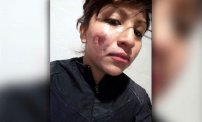 Encapuchada atacó con ácido en la cara a mujer policía de la CDMX